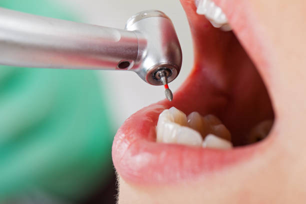 Best Lost Filling or Crown Replacement in Beesleys Point, NJ